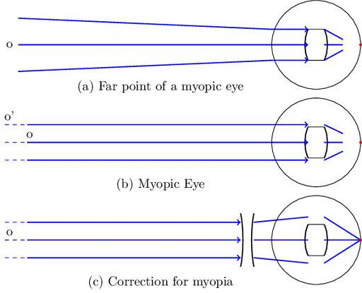 Myopia correction diagram